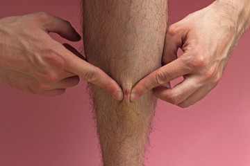 a man scratches an old wound on his leg. tear off a dried crust from a scratch
