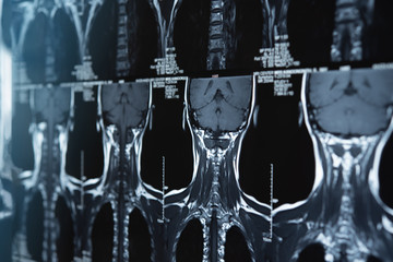 cervical spine x-ray film - obrazy, fototapety, plakaty