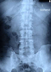 x-ray images spine