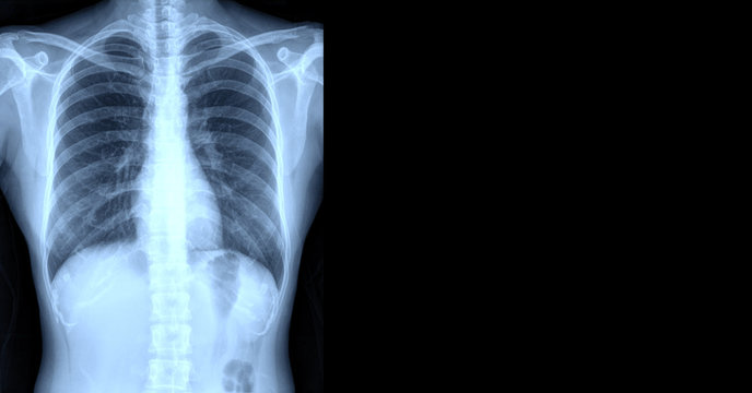 x-ray chest lung