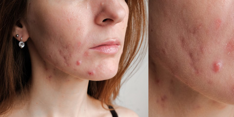 Close up of a woman's skin with acne eruptions. Treatment of blackheads.