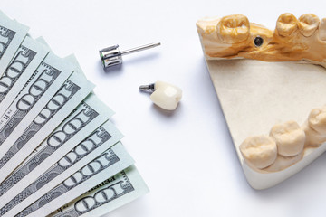 ceramic tooth implant lies with a dental tool and a model of teeth with an implant on a white background. to the left of the tooth are banknotes of dollars. concept of the high cost of dentistry 