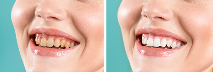 Close-up of a smiling woman before and after teeth whitening. Yellow, dark teeth. White, bright...
