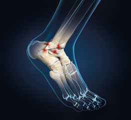 Torn ligament in ankle, medically 3D illustration