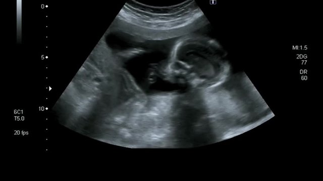Fast motion of an ultrasound examination of a pregnant woman with an embryo and luminous lines, echography of fetus