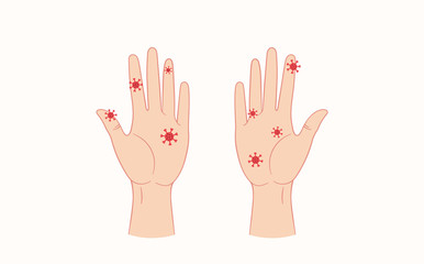 Virus on humans hands. Vector flat style illustration isolated on white background