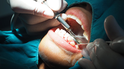 Dentists are treating gingivitis by scaling.