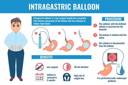 Intragastric balloon medical infographic banner.  Benefits and medical procedure phases.  Male patient losing weight with gastric balloon in stomach. Health care concept. Vector illustration.