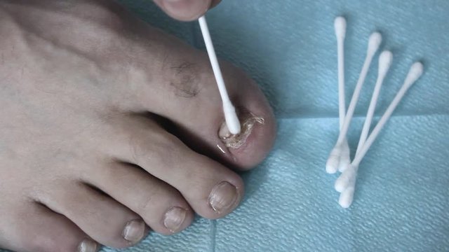 A doctor treats a diseased nail with a cotton swab. The damaged nail.