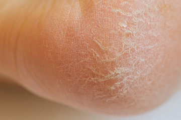 Closeup of horny skin on a heel