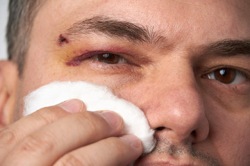 close view of a bruise near the eye, the face of a man with a hematoma