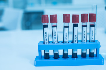 Positive COVID-19 test and laboratory sample of blood testing for diagnosis new Corona virus infection
