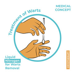 Round icon about the treatment of warts. Burning a wart with liquid nitrogen. A hand holds a stick with nitrogen and burning a wart on his hand