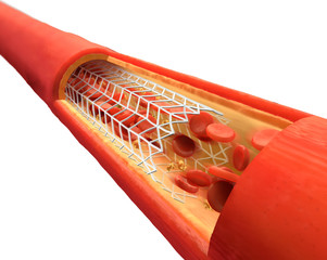 3D illustration of a bypass stent - chronic coronary heart disease
