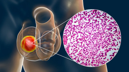Testicular seminoma, germ cell tumor of the testis