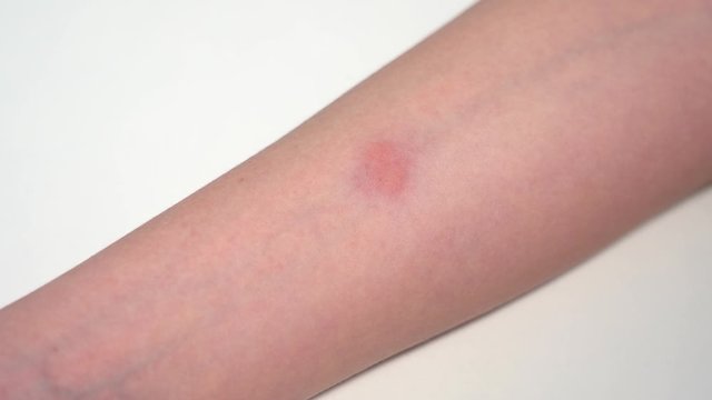 Closeup view 4k video of child hand with red spot reaction to conducting Mantoux test after 72 hours from injection.