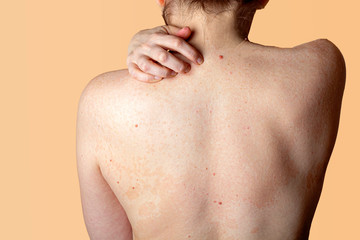 Allergic dermatitis on the skin of a woman's back. Skin disease. Neurodermatitis disease, eczema or...