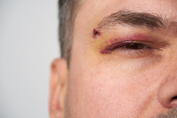 close view of a bruise near the eye, the face of a man with a hematoma