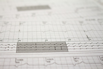 Three-channel Holter EKG strip showing heartbeat waves. Electrical activity of the heart recorded on paper.