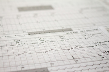 Three-channel Holter EKG strip showing heartbeat waves. Electrical activity of the heart recorded on paper.