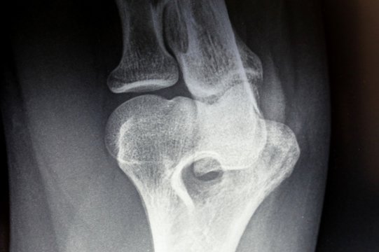 Orthopedic X-ray image for medical diagnosis and treatment 