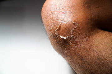 Fototapeta premium Peeling the skin on the knees 