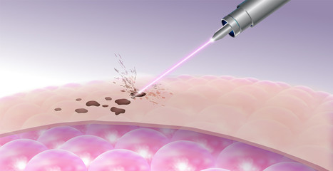 Details for laser freckles and dark spot removal On the upper skin Does not affect the cells under the skin. Realistic file.