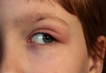Barley in the eye. A child with barley in his eye. Inflammation of the eyelid. Human disease.