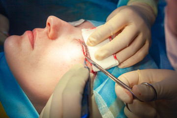 Close up of the face of a patient who is undergoing blepharoplasty. The surgeon cuts the eyelid and...