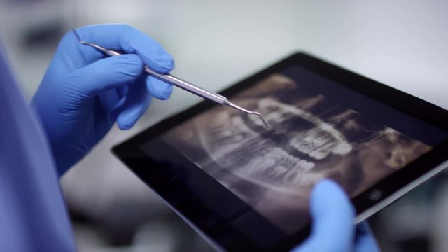 Close up of gloved hands of unrecognizable dentist holding periodontal scaler and pointing at jaw x-ray on tablet