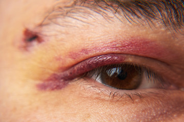 close view of a bruise near the eye, the face of a man with a hematoma