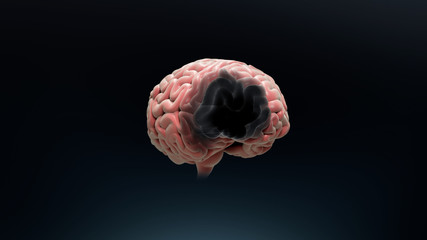 Brain necrosis, sick brain slowly decays