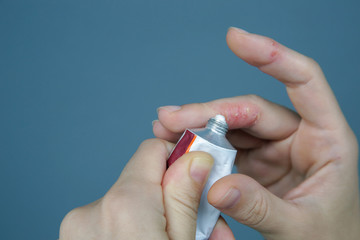 Atopic hand dermatitis. Eczema on the fingers. 