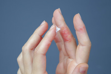 Atopic hand dermatitis. Eczema on the fingers. 