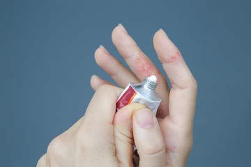 Atopic hand dermatitis. Eczema on the fingers. 