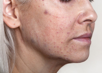 Consequences on the skin of the face, resulting from beauty injections-biorevitalization. Correction of age-related changes.