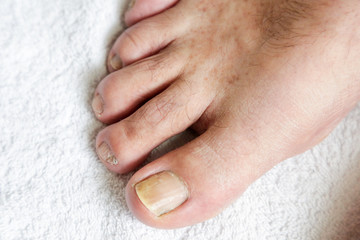 Details of man nails with fungal infection known as onicomycosis, natural light