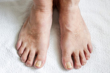 Details of man nails with fungal infection known as onychomycosis, natural light