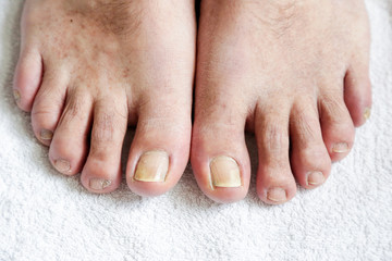 Details of man nails with fungal infection known as onychomycosis, natural light