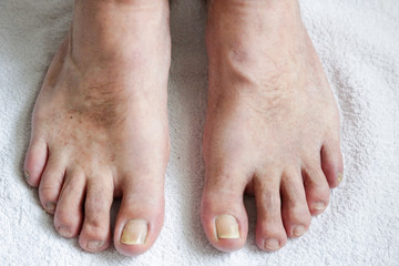 Details of man nails with fungal infection known as onychomycosis, natural light
