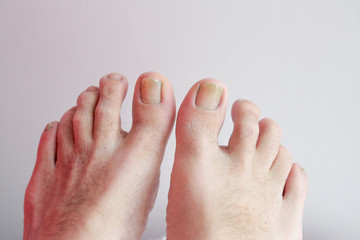 Details of man nails with fungal infection known as onychomycosis, natural light