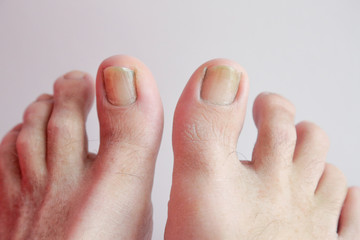 Details of man nails with fungal infection known as onychomycosis, natural light