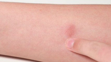 Closeup view 4k video of child hand with red spot reaction to conducting Mantoux test after 72 hours from injection. Kid touching place of injection with finger.