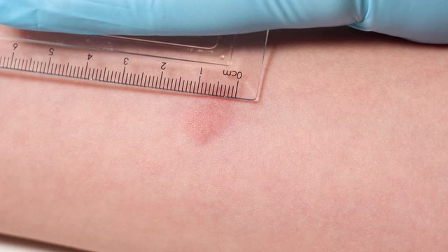 Closeup view 4k video of child hand with red spot reaction to conducting Mantoux test after 72 hours from injection. Nurse in blue gloves applying transparent ruler to check reaction.