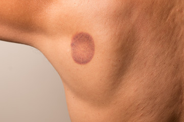 Fototapeta premium Patient that had cupping therapy done on his upper back 