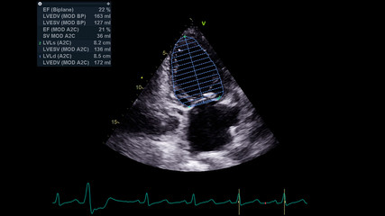 Image of the heart in gray-scale mode during transesophageal ultrasound.