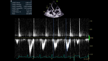 Image of the heart in gray-scale mode during transesophageal ultrasound.