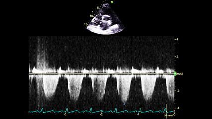 Image of the heart in gray-scale mode during transesophageal ultrasound.
