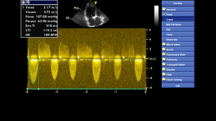 Image of the heart in gray-scale mode during transesophageal ultrasound.