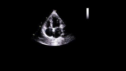 Image of the heart in gray-scale mode during transesophageal ultrasound.